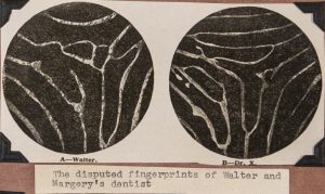 Two photomicrographs of fingerprints placed side by side. The left fingerprint is labeled "A--Walter." The right fingerprint is labeled "B--Dr. X." A caption at the bottom reads: "The disputed fingerprints of Walter and Margery's dentist."